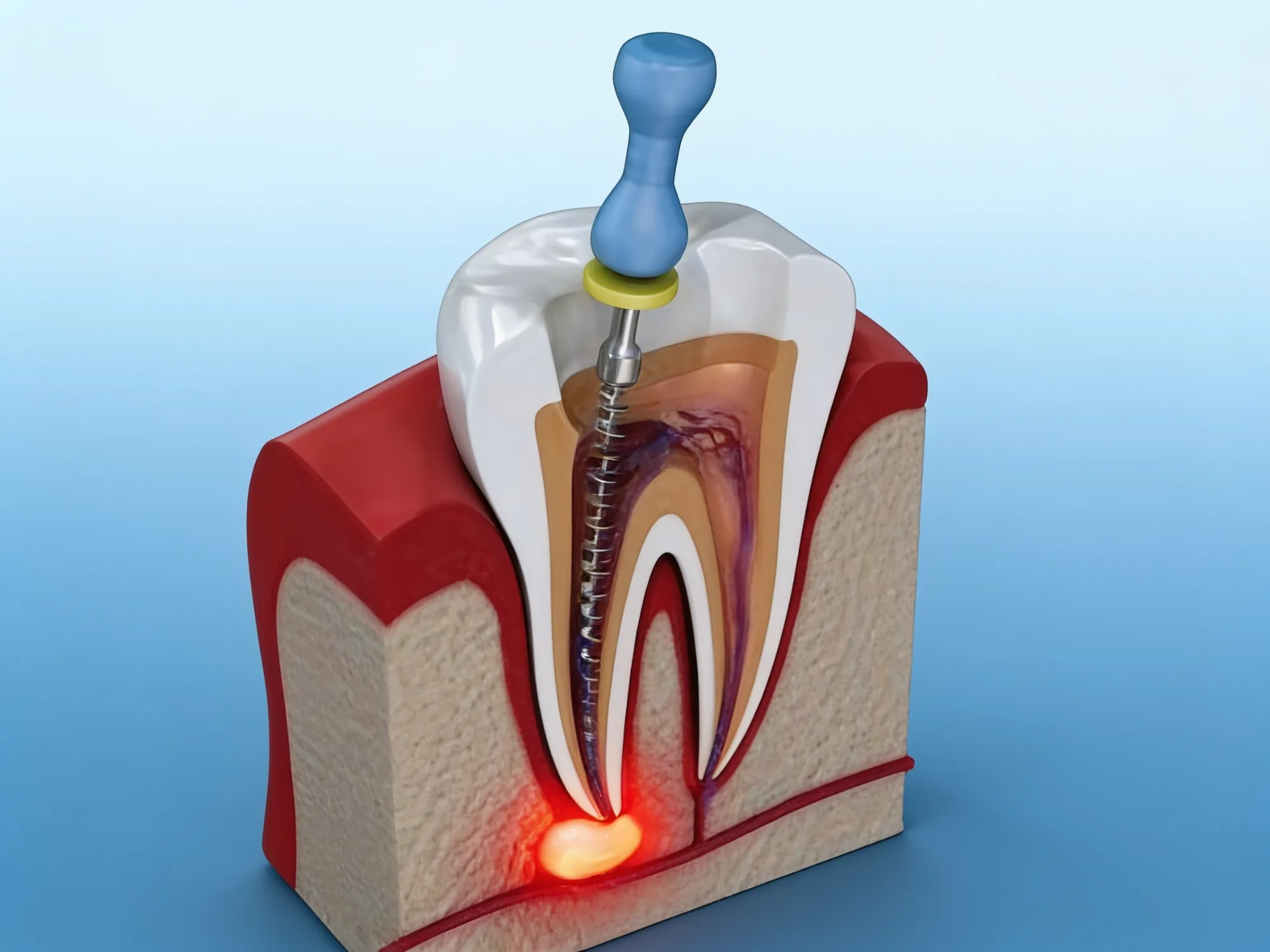 Cross-section of a tooth showing a root canal file cleaning the infected canal in Grande Prairie