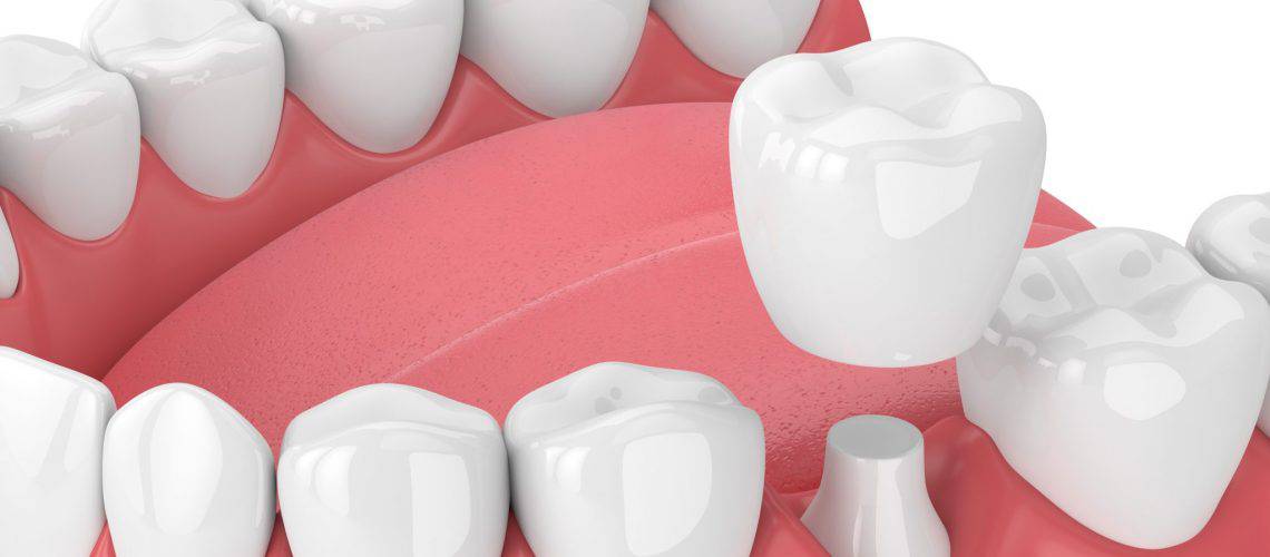 A 3D illustration showing a dental crown being placed onto a prepared tooth, with surrounding teeth and gum tissue visible—perfect for showcasing dental procedures at a dental grande prairie clinic.