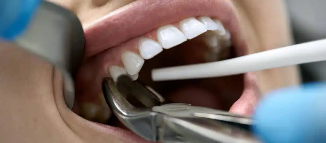 root-canals-featured-image A close-up of a dental procedure at Dental Grande Prairie shows forceps extracting a tooth from a patient’s open mouth, with dental tools and gloved hands visible.